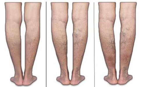 The stage of varicose veins