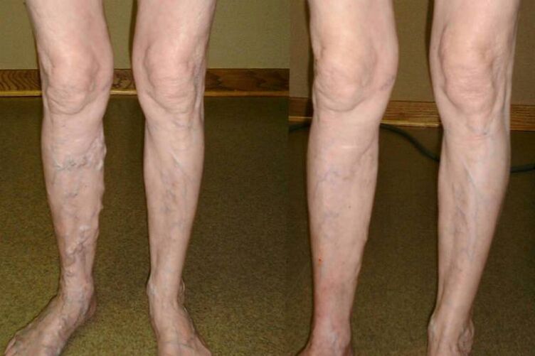 Male varicose veins