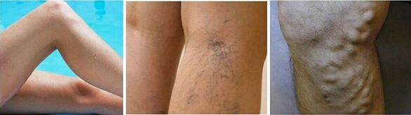 Appearance of varicose veins on the legs