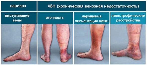 The stage of varicose veins