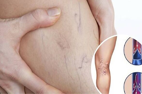 Varicocele photos