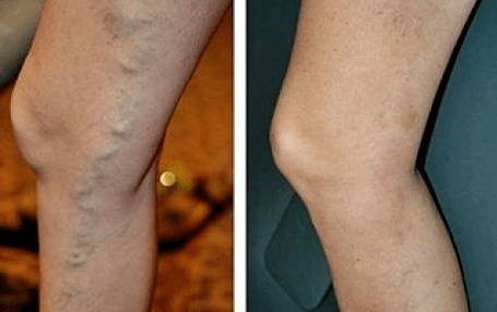 Before and after varicose veins