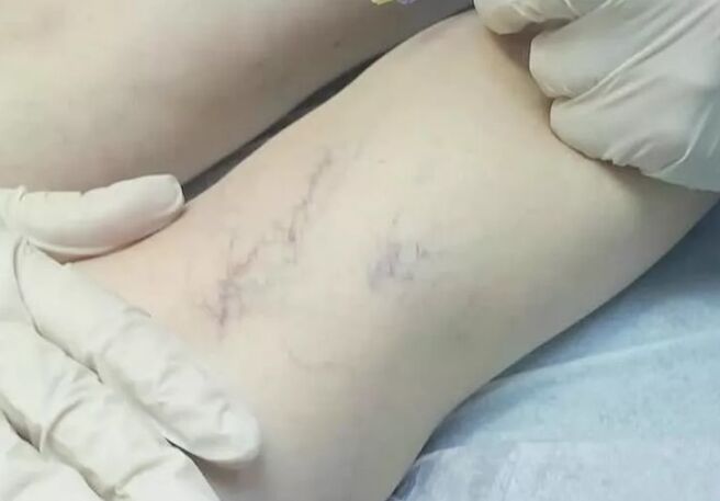 Complications after surgery