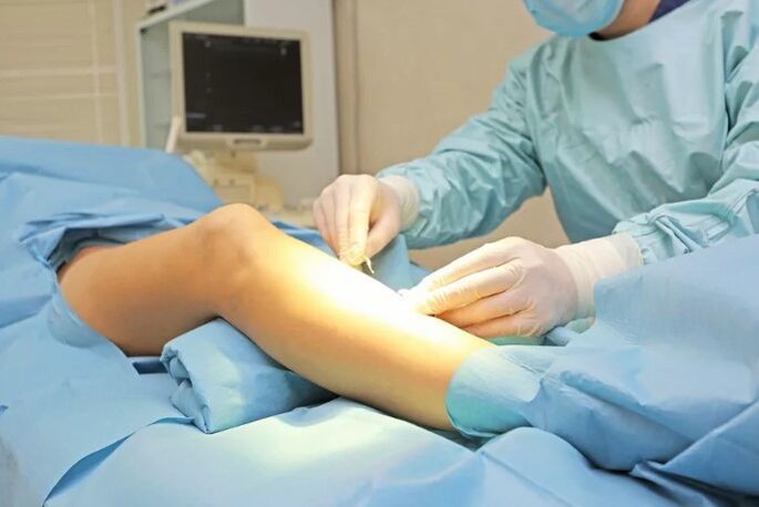 Surgery to remove veins from the legs