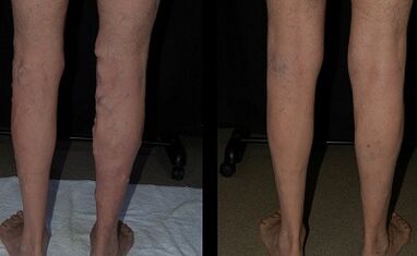 Treat varicose veins with laser photos before and after