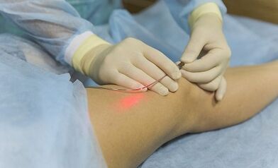 Treat varicose veins with laser