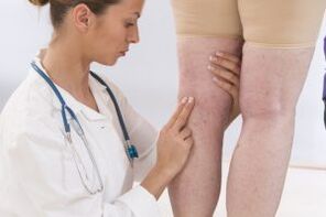Phlebologist examining patient with varicose veins