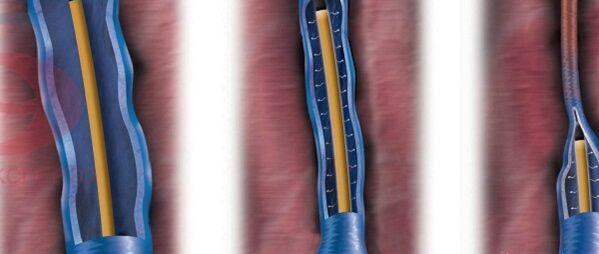 The essence of radiofrequency ablation in treating varicose veins