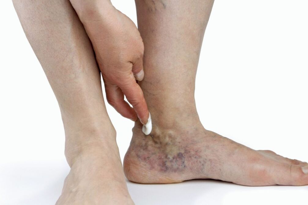 Varicose veins of lower limbs